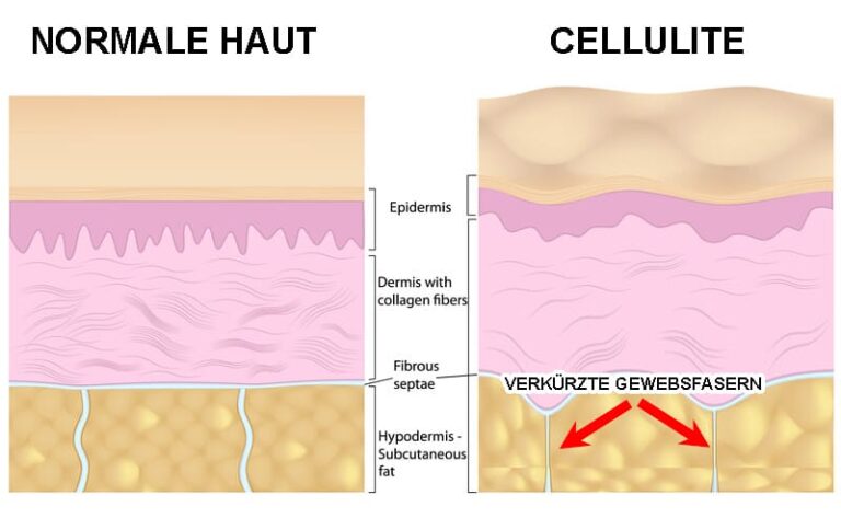 Was Hilft Gegen Cellulite Diese 3 Dinge Bekämpfen Dellen 2945